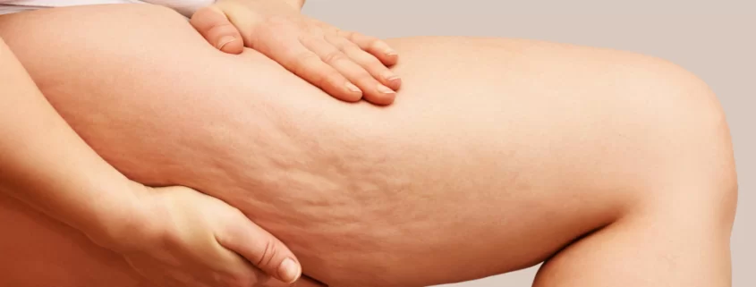 Mesotherapy for Cellulite Reduction